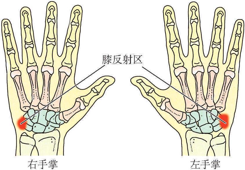 (二)小兒生長性骨痛